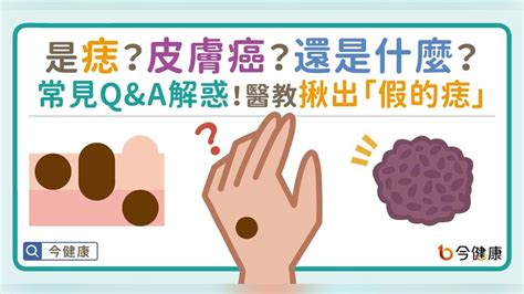 痣中痣|是痣？還是皮膚癌？皮膚科醫師教你揪出「假的痣」，。